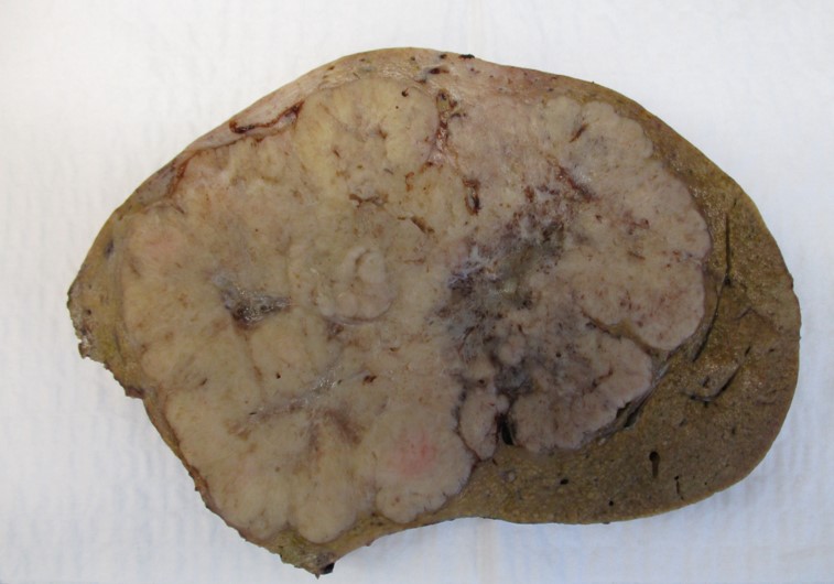 Colangiocarcinoma intraepatico