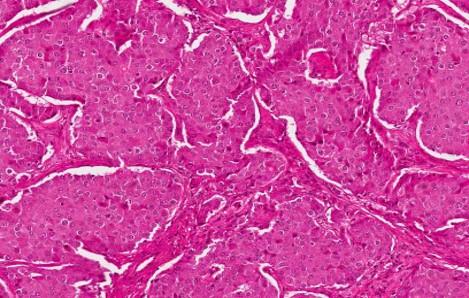 metastasi epatiche da neoplasie colorettale